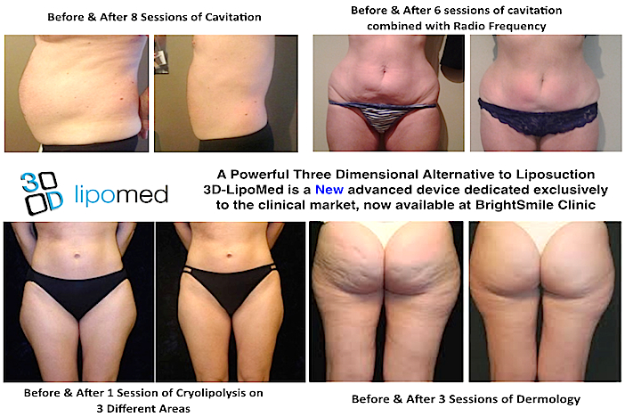 beforeafterlipomed-1411036746.jpg