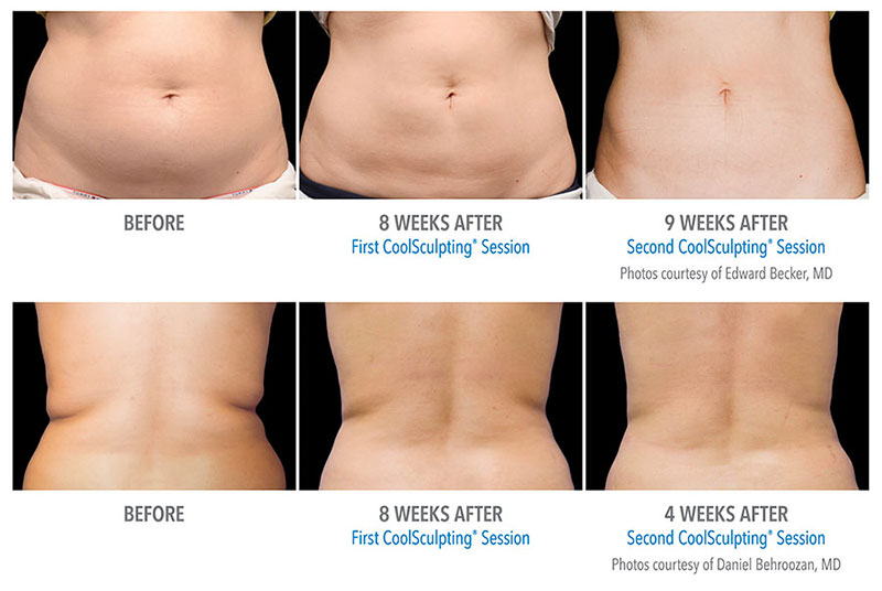 coolsculpting-before-after.jpg